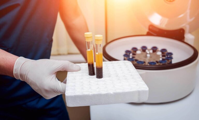 Platelet-rich plasma (PRP) prepared for regenerative treatment
