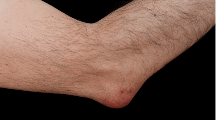 What Causes Bursitis To Flare Up Advanced Sports And Spine