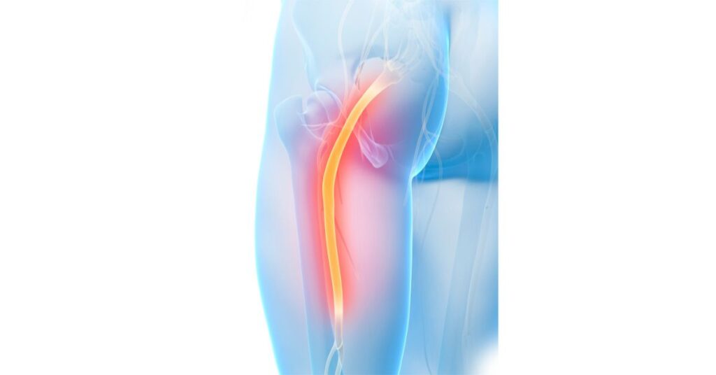 How Long Does Sciatica Last? Recovery Timeline by a Physiatrist