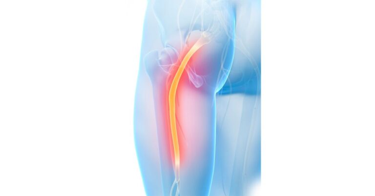Sciatic nerve pathway showing pain radiating from the lower back through the buttock and down the leg — sciatica recovery guide by Charlotte physiatrist Dr. Usman Ahmad