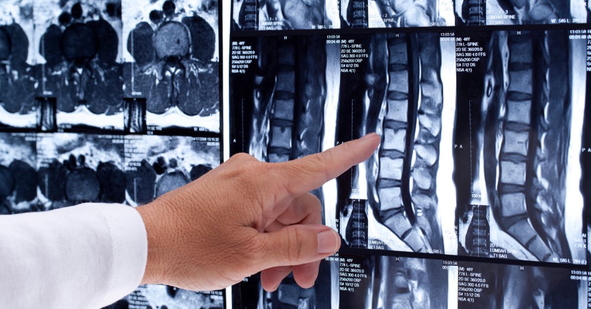 Physiatrist reviewing a lumbar spine MRI with a patient before an epidural steroid injection at Advanced Sports & Spine in Huntersville, NC